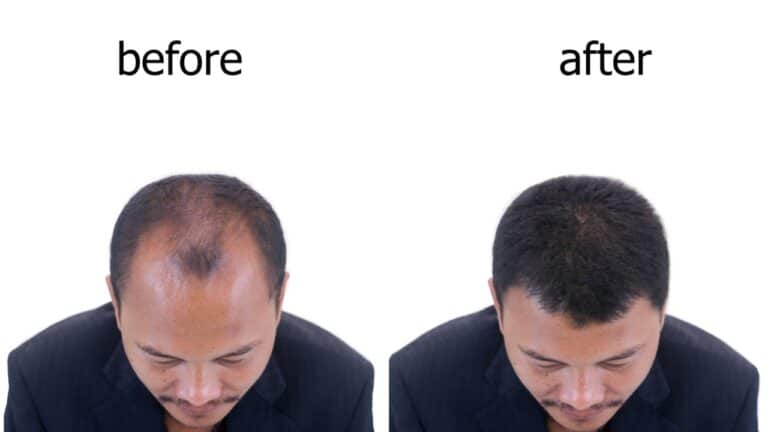 thin and thick hair before and after